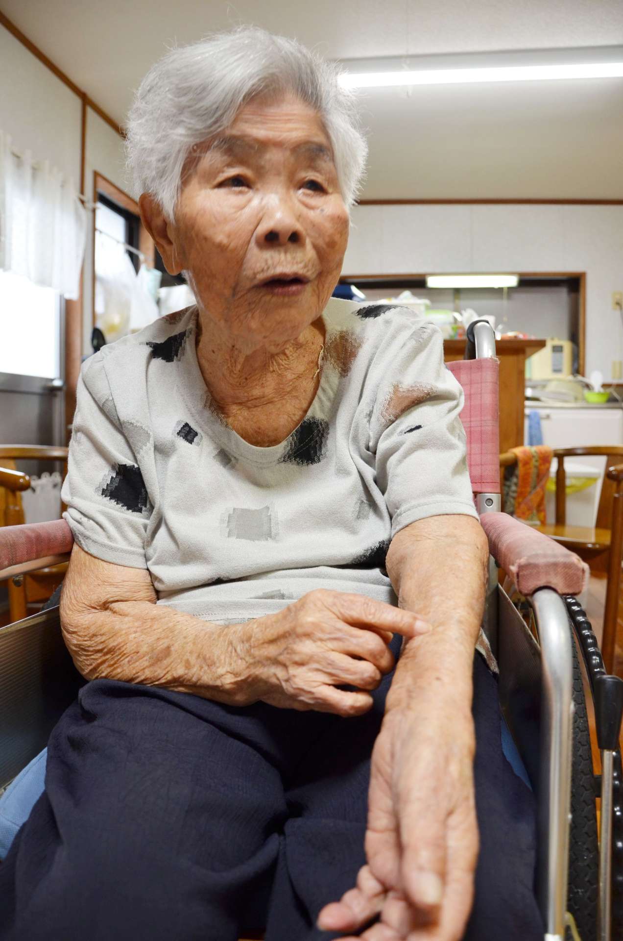 長崎で被爆し、左腕には長くガラス片が埋まっていた笠利イモコさん＝６月、奄美市笠利